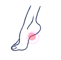 Plantar Faciitis